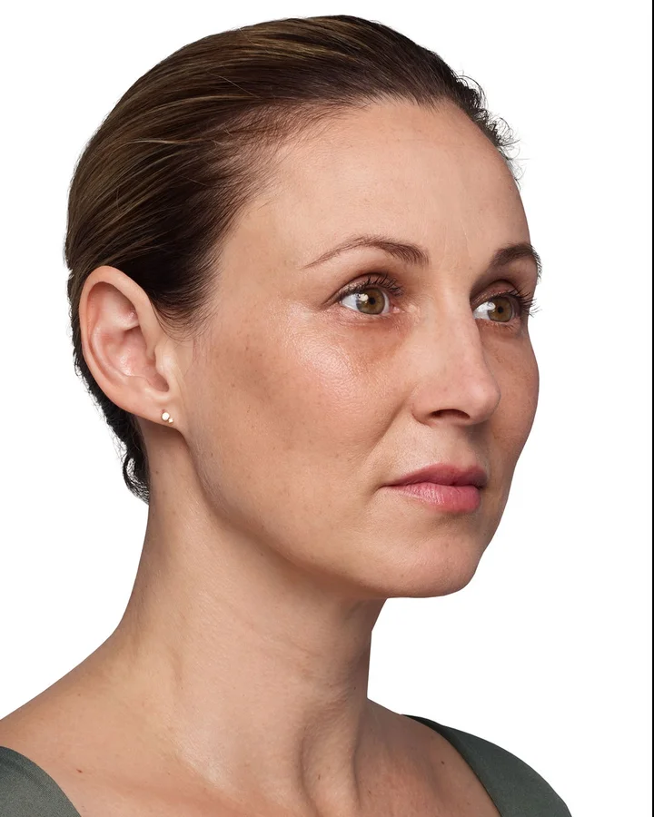 Headshot Kate - Juvederm After 1 syringe in the cheeks After 1